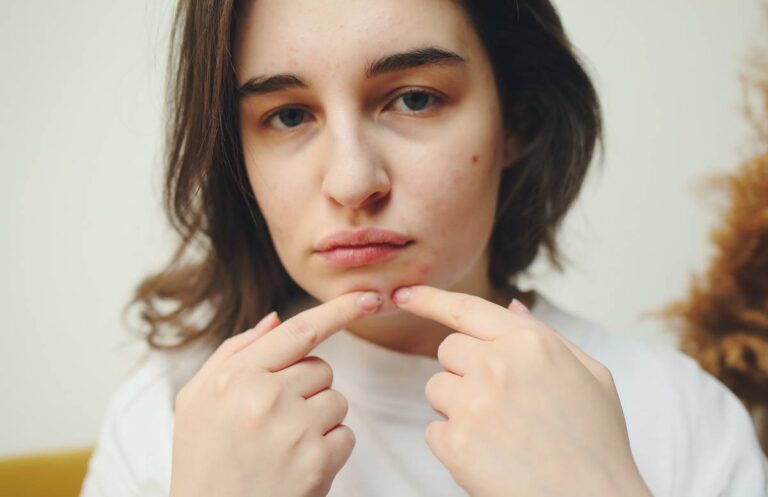 Jak pozbyć się trądziku skuteczne sposoby na zdrową skórę