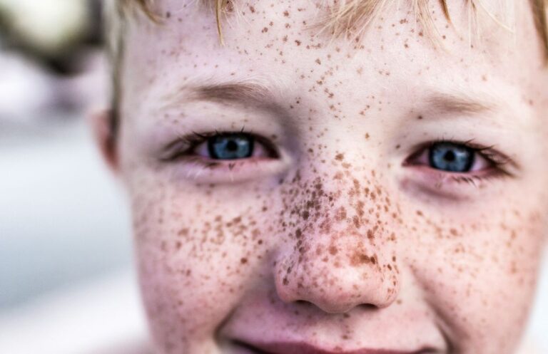 Jak pozbyć się piegów Skuteczne metody i porady