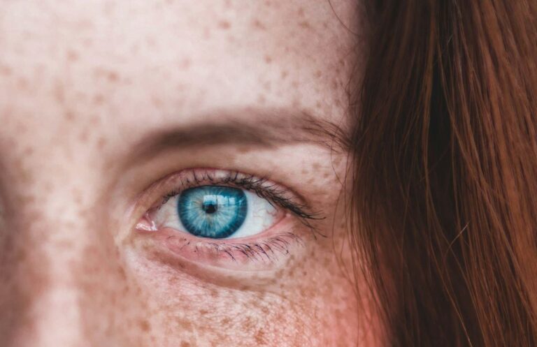 skóra naczynkowa - przyczyny, objawy i leczenie