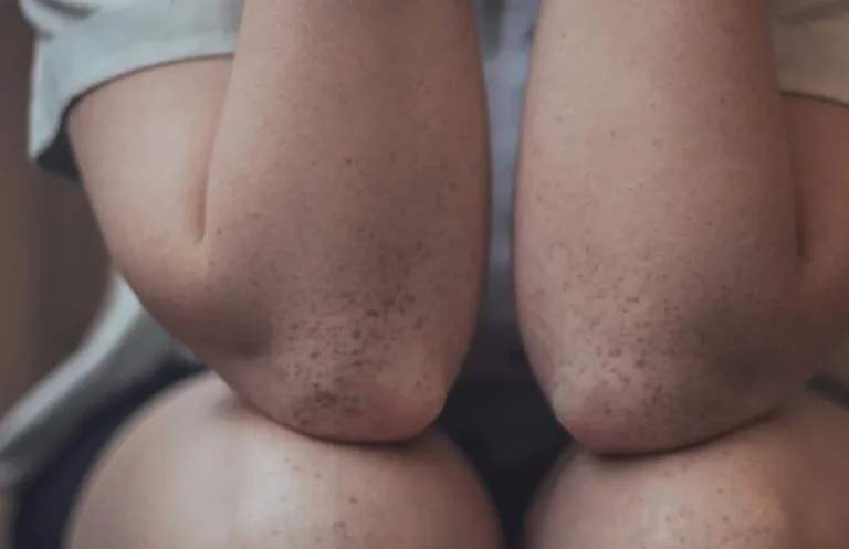 Sucha skóra na łokciach – 6 ważnych przyczyn