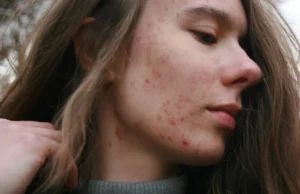 zmiany hormonalne na skorze 8 duzych powodow